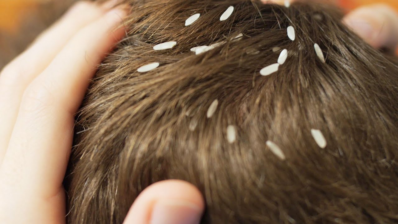 lice in adults