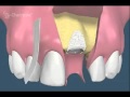 Implant dentaire et régénération osseuse guidée