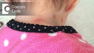 Does swelling & redness point toward spider bite? - Dr. Nischal K