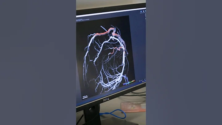 DISCOVERY: New Biomarker for Vascular Aging and Neurodegeneration #AgingResearch #VascularAging