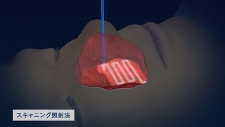 国立がん研究センター東病院　放射線治療科「陽子線ラインスキャニング照射法」のご紹介【国立がん研究センター東病院】
