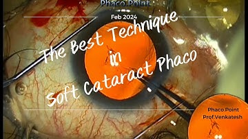The Best Technique In Soft Cataract Phacoemulsification - In my Opinion.