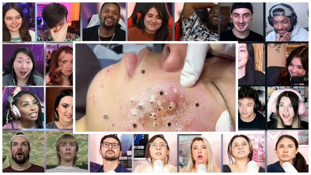 Acne Blackheads Whiteheads Removal Day With Dr Mozan Most Disturbing Pimple Popping Reaction Mashup