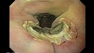 Icd 10 gastroesofágicas varices