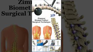 Zimmer Biomet Tether Surgical Technique medical animation 3d short