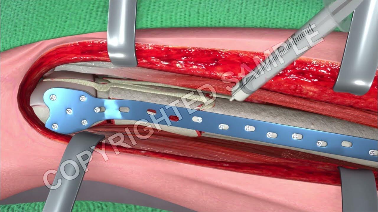 Hemiarthroplasty Vs Orif Hip