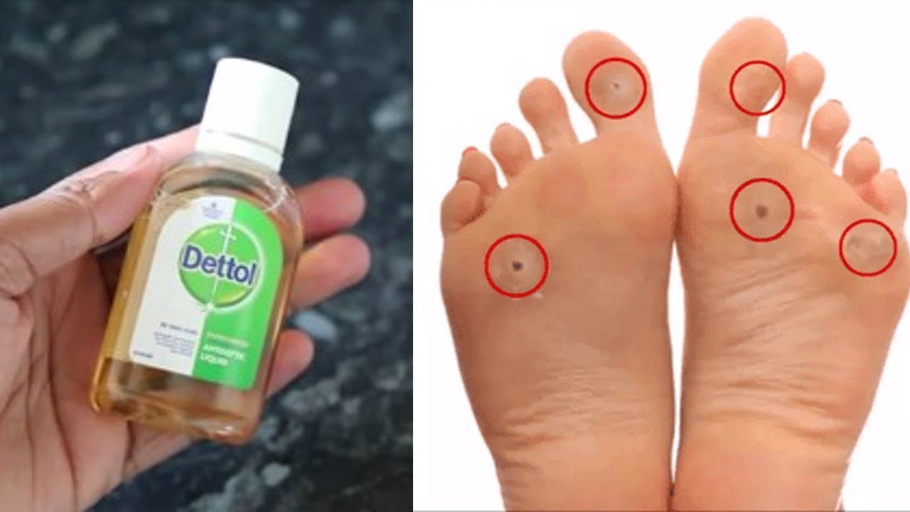 MAGIC DETTTOL JUST ONE HOUR How To Remove Foot Corn Or Callus At