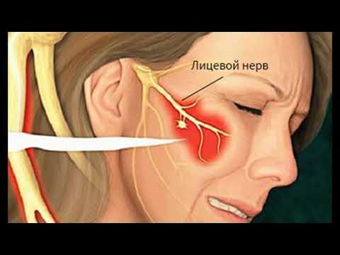 Как быстро снять боль тройничного нерва