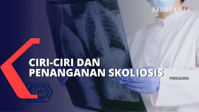 Yoga Sebagai Alternatif Penyembuhan Holistik Pasien Skoliosis - Health