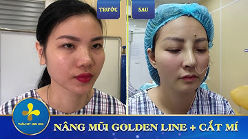 Khách hàng thay đổi bất ngờ cùng COMBO NÂNG MŨI - CẮT MÍ GOLDEN - Thẩm Mỹ Như Hoa