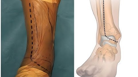 Extensile Antero- Lateral Approach to the Tibia