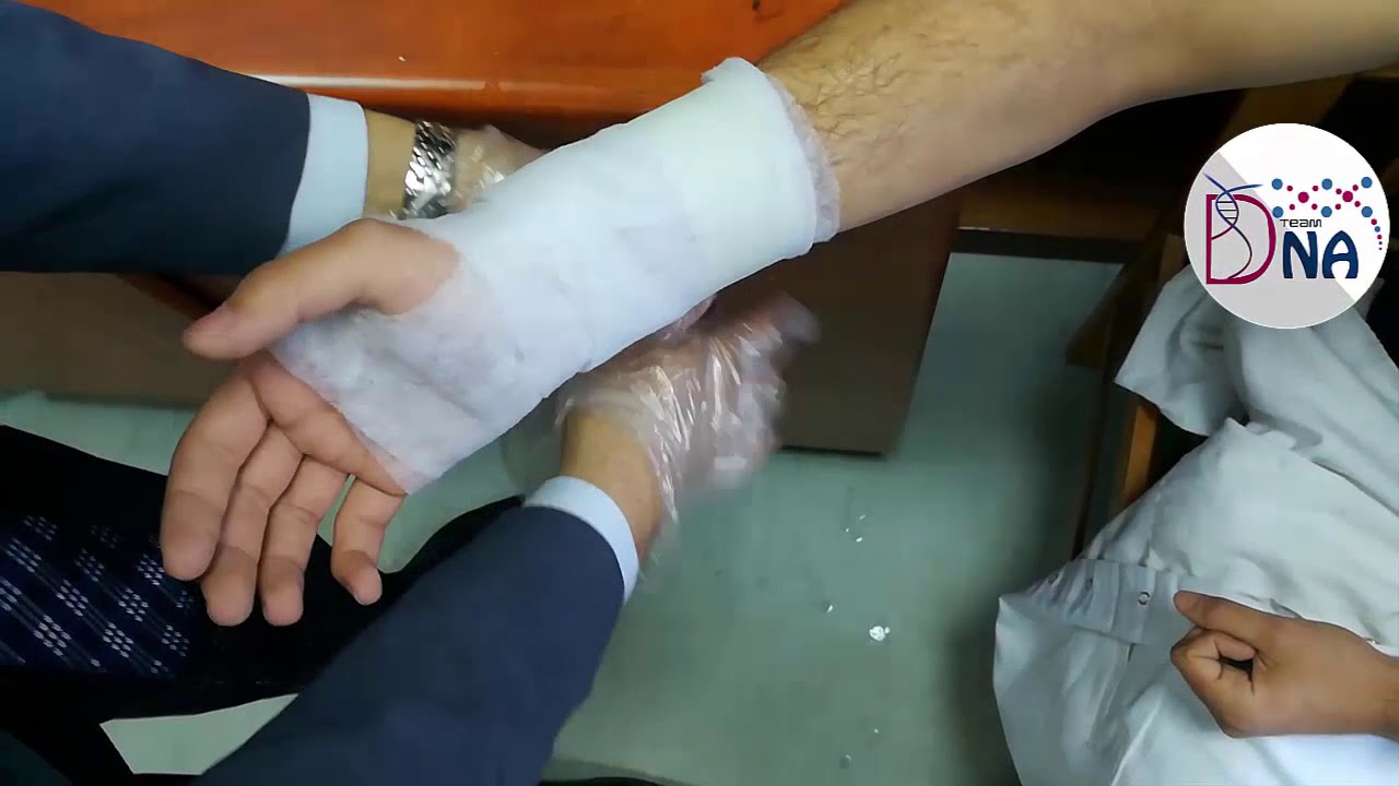 جلسة الجبائر جبيرة الجبس البلاستيكية YouTube