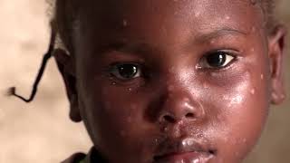 WARNING: GRAPHIC CONTENT - Africa's monkeypox cases and deaths go unreported