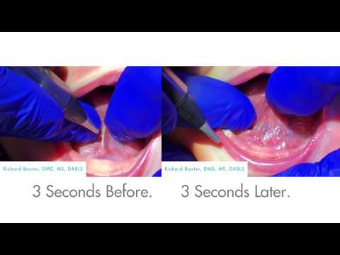 3 Second Tongue-Tie Release by Richard Baxter, DMD