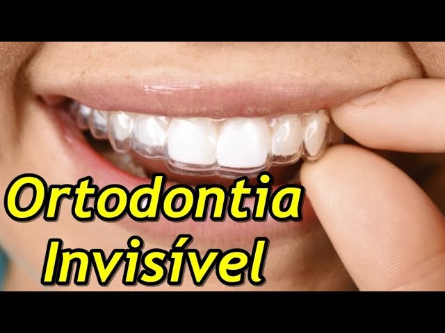 Como funciona o alinhador dental transparente? - Ortodontia Curitiba