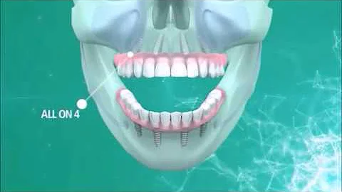 All-on-Four Animated Video