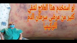 لو استخدم هذا العلاج لشفي كثير من مرضى سرطان الدم اللوكيميا المرض الفتاك