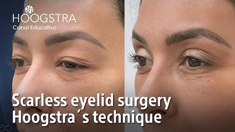Scarless eyelid surgery - Hoogstra´s technique - 22223