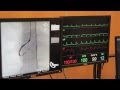 Cardiac Catheterisation Part 2 - Right Coronary