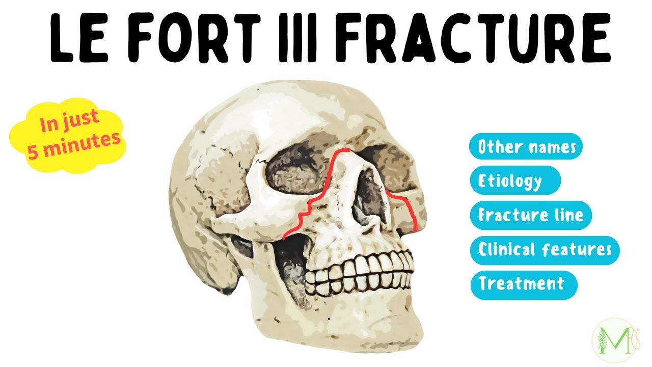 Le Fort III Fracture Made easy in 5 Minutes Medinare YouTube