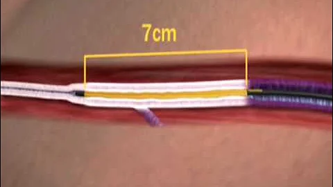 The VNUS Closure Procedure Using ClosureFAST Catheter
