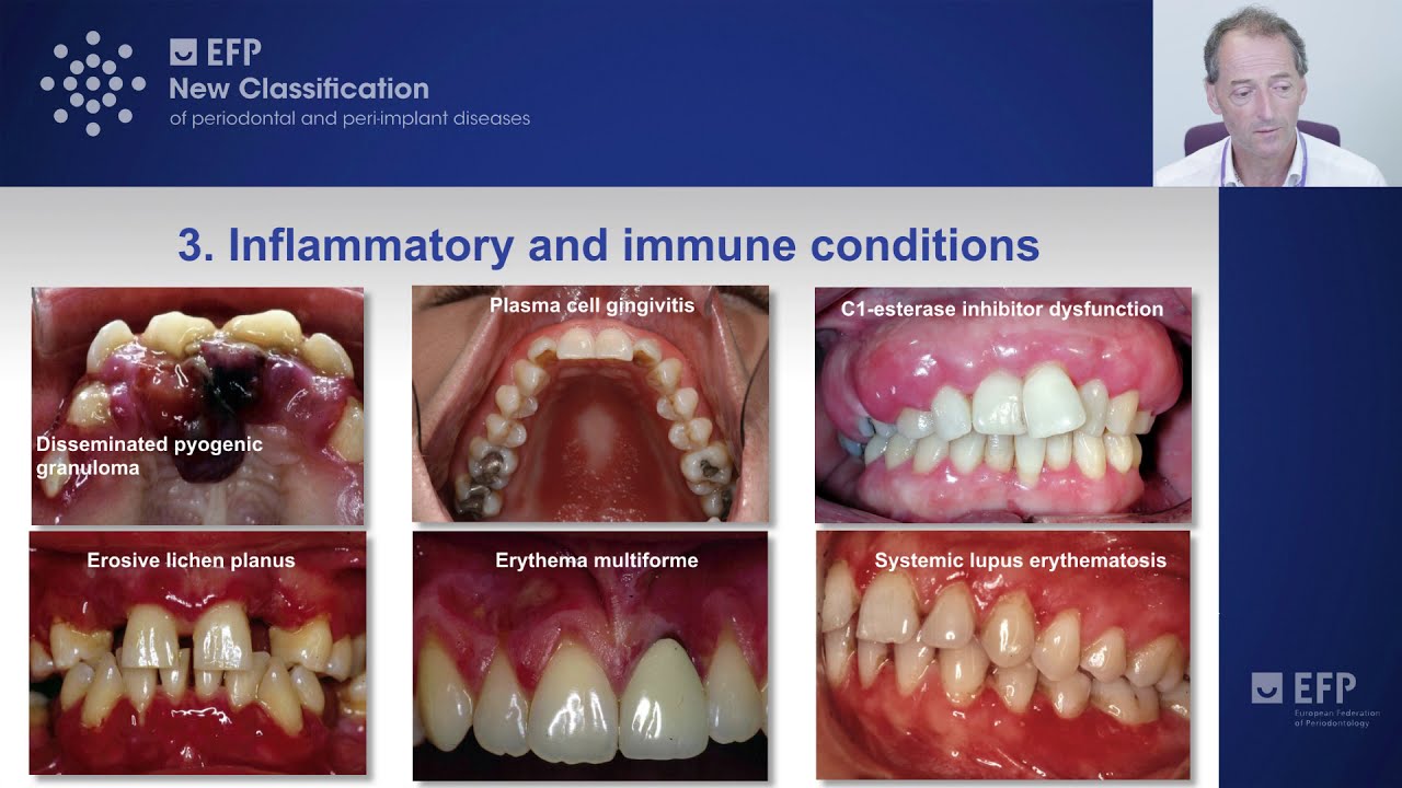 Nonplaqueinduced gingival diseases tutorial by Iain