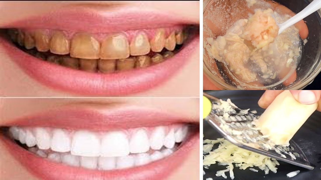 Get whitening Teeth With Ginger Paste Just In 2 Minutes Surprising