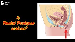 5 Symptoms to recognize Rectal Prolapse: Causes, Treatment - Dr. Rajasekhar M R | Doctors' Circle
