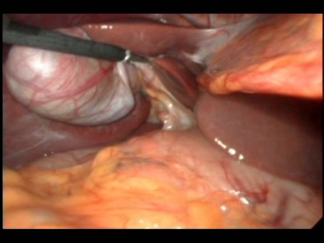 Operacion de vesicula por laparoscopia - youtube