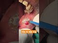 Verrucous carcinoma/ Verrucous hyperplasia excision laser, cautery - Dr Hitesh Patel
