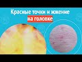 😮 Красные точки и жжение на головке. Клинический случай №1227