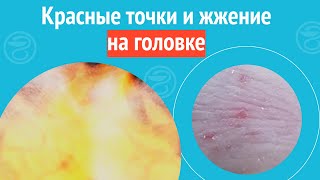 😮 Красные Точки И Жжение На Головке. Клинический Случай №1227