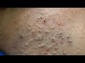 [ASMR] Korean Skincare Routine for Acne and Blackheads, Satisfying Facial Care