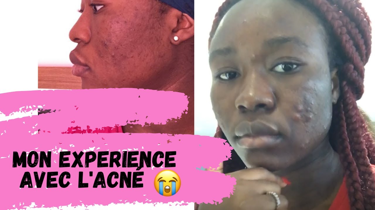 MON EXPÉRIENCE AVEC L'ACNÉ & TÂCHES // MA SOLUTION !