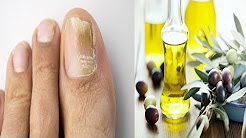 vinagre y bicarbonato para uñas encarnadas