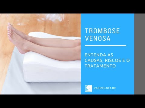 Vídeo: Trombose Da Veia Sural - Sintomas E Tratamento