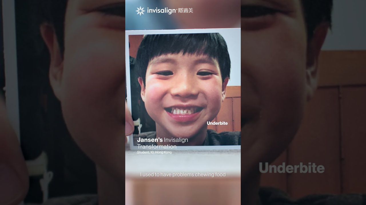 Jansen S Invisalign Transformation InvisalignSG Invisalignsmile