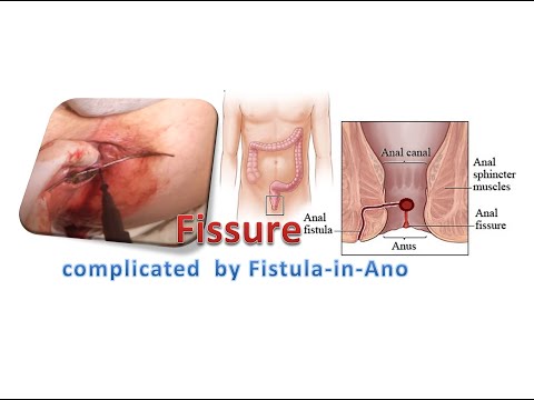 Como funciona una fistula arteriovenosa