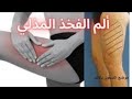 الم الفخذ المذلي علاج الم وحرقان اعلي الفخذ الم الفخذ الم الفخذ دكتوراحمدحسن جمعه