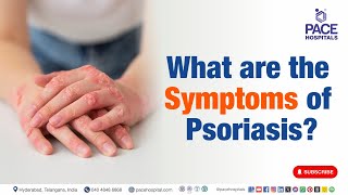 Symptoms of Psoriasis | What are the Symptoms of Psoriasis? | #psoriasis