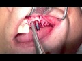 Extraction implant placement augmentation procedure using b