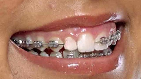 Remove Braces with Photoshop