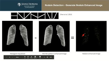 Chest X-ray segmentation and lung nodule detection