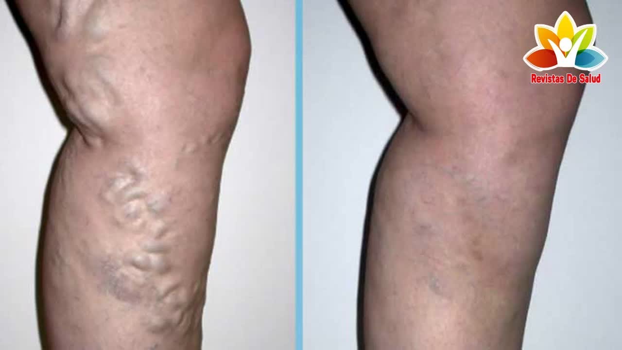 Aprende a cómo combatir las varices con remedios naturales.