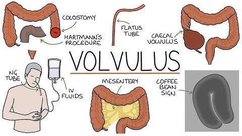 Volvulus (Twisted Bowel) | Drk