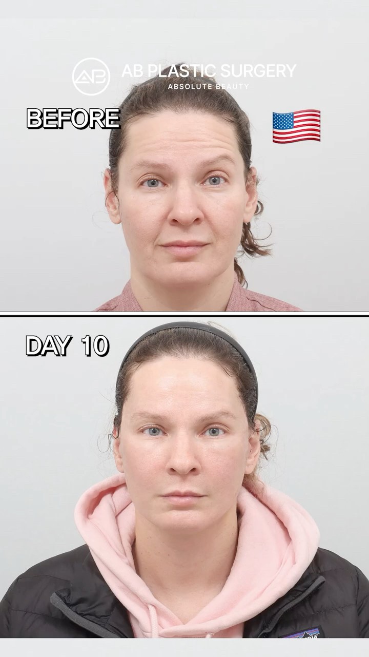 Facelift Transformation | Before & After Rejuvenation #shorts