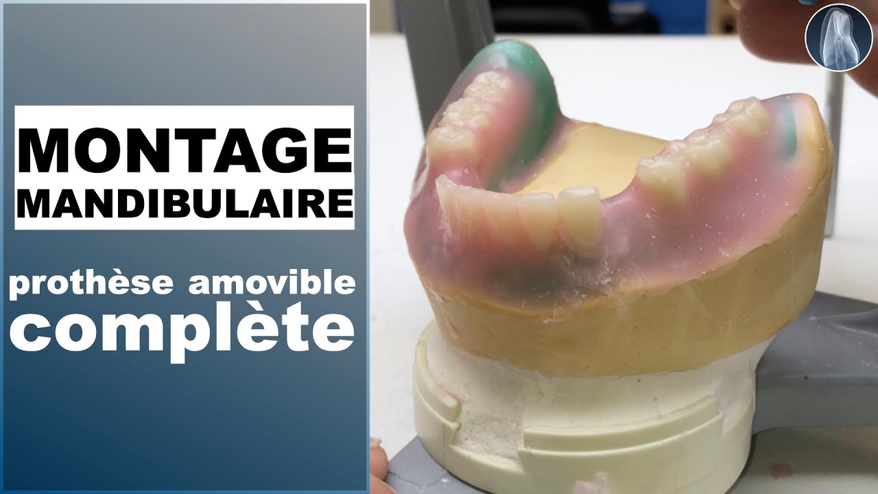 Montage des Dents d’une Prothèse Amovible Complète Mandibulaire – Protocole Gysi Détaillé ! 🦷✨
