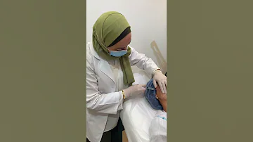 احدث تقنيه شد البشرة عالميا جلسة السكلبترا Sculptra عند خبراء التجميل 