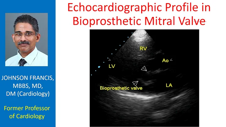 Echocardiographic profile of bioprosthetic mitral valve