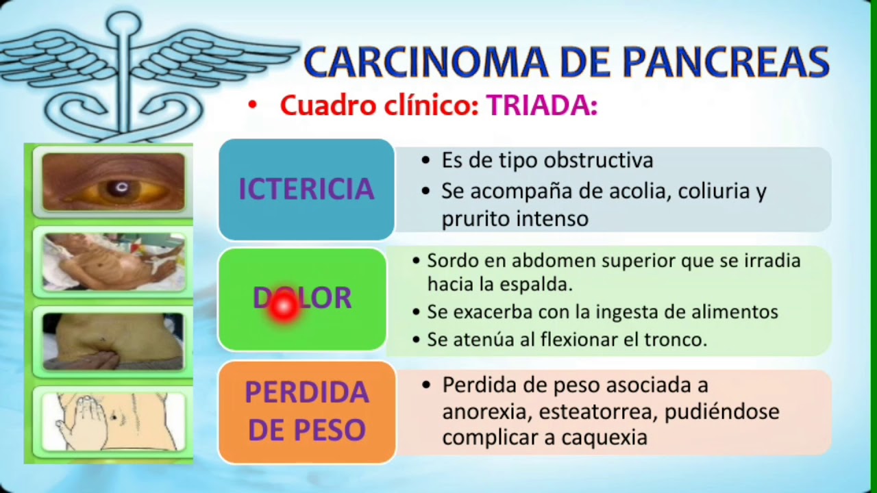 CÁNCER DE PÁNCREAS - YouTube